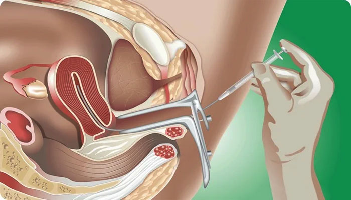 Intra Uterine Insemination